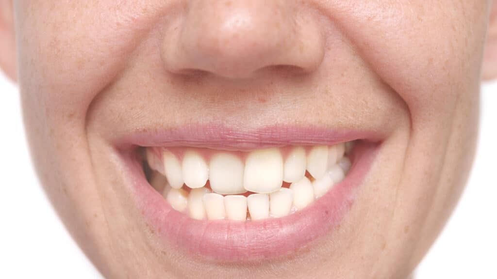 Crooked Teeth - Carlisle Dentist