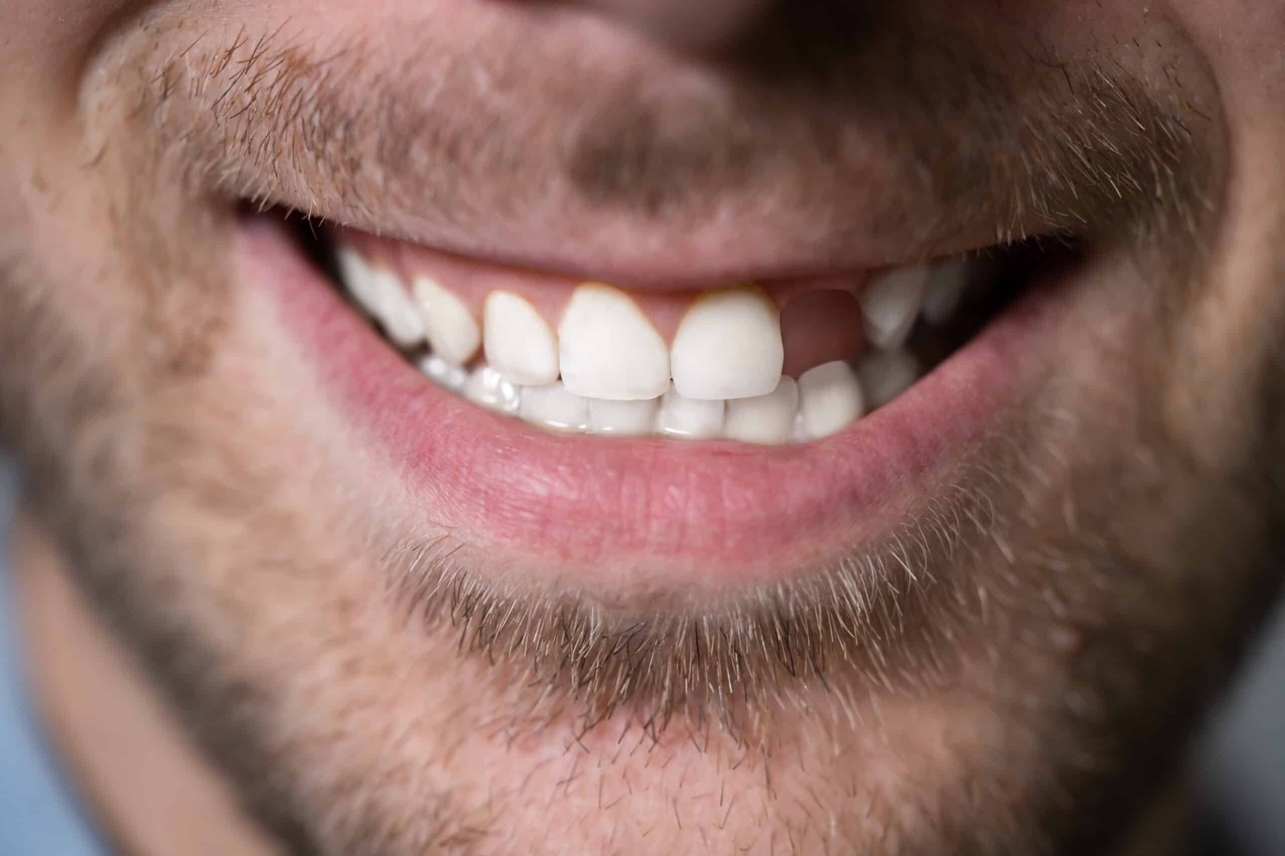 Люди с отсутствующими зубами