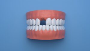 Why you should replace missing teeth
